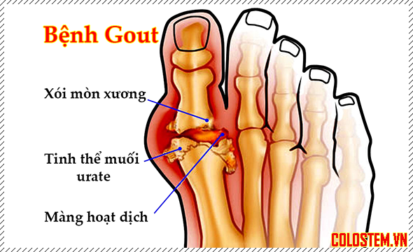 bệnh gout